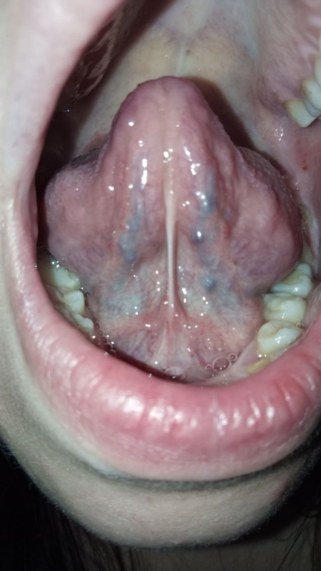 hiv symptoms mouth