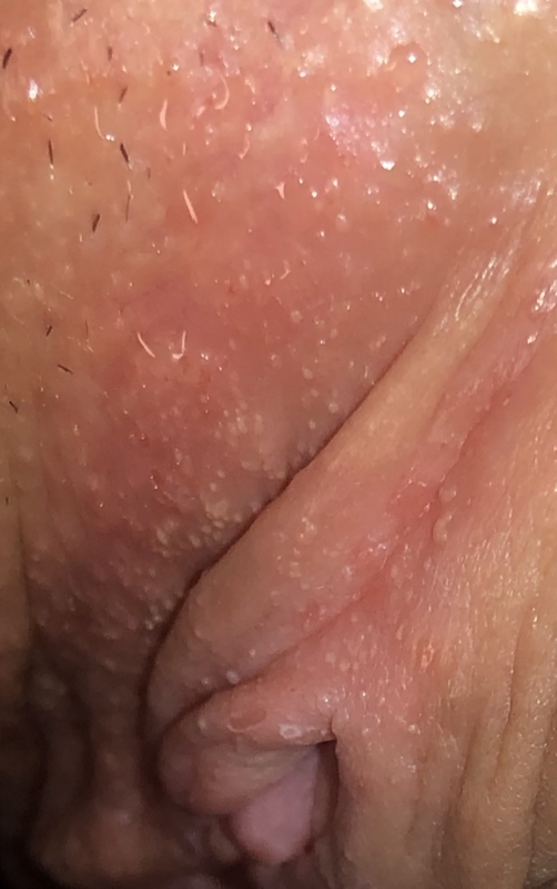 Itchy and dry vagina