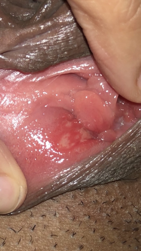 yeast infection sores