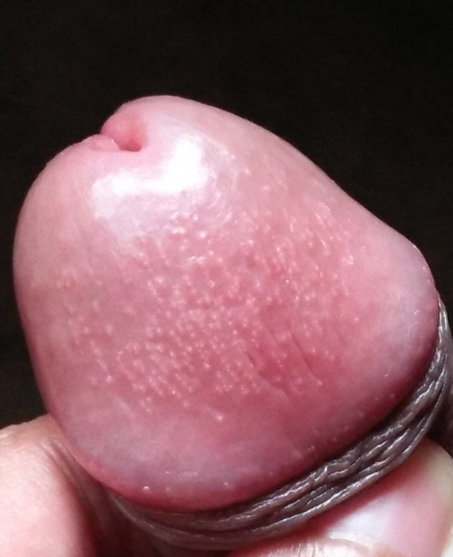 Artificial penile pearls
