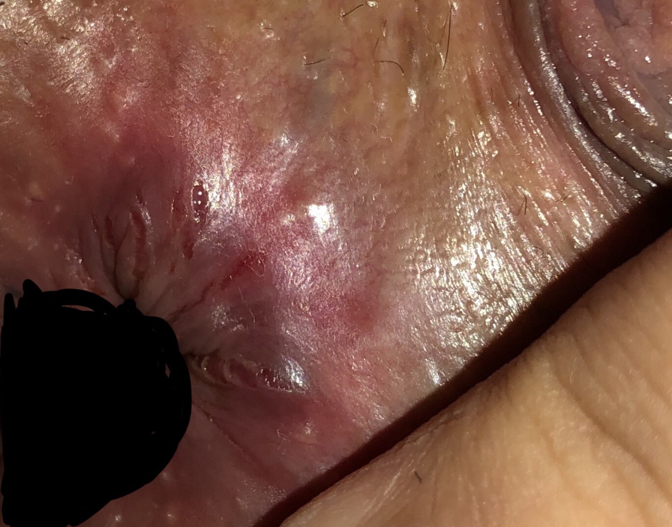 navneord Vend om præambel Pic (Ls in anal area) | Lichen Sclerosus | Forums | Patient
