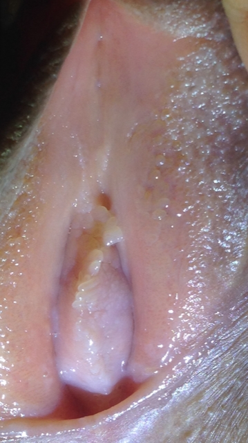 hpv causes warts