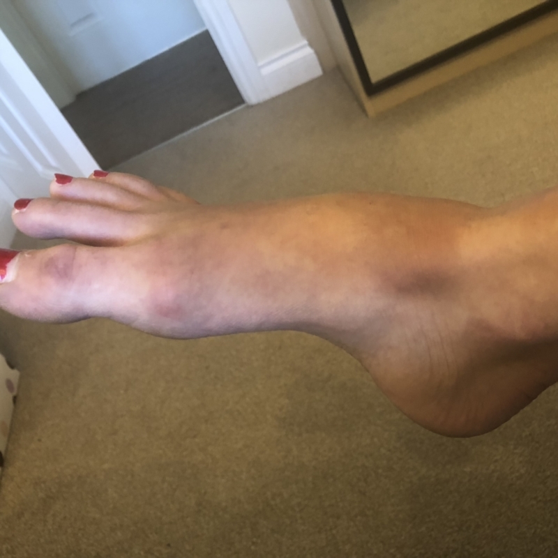 Suspected broken foot? - Foot and Toe Problems - Forums - Patient