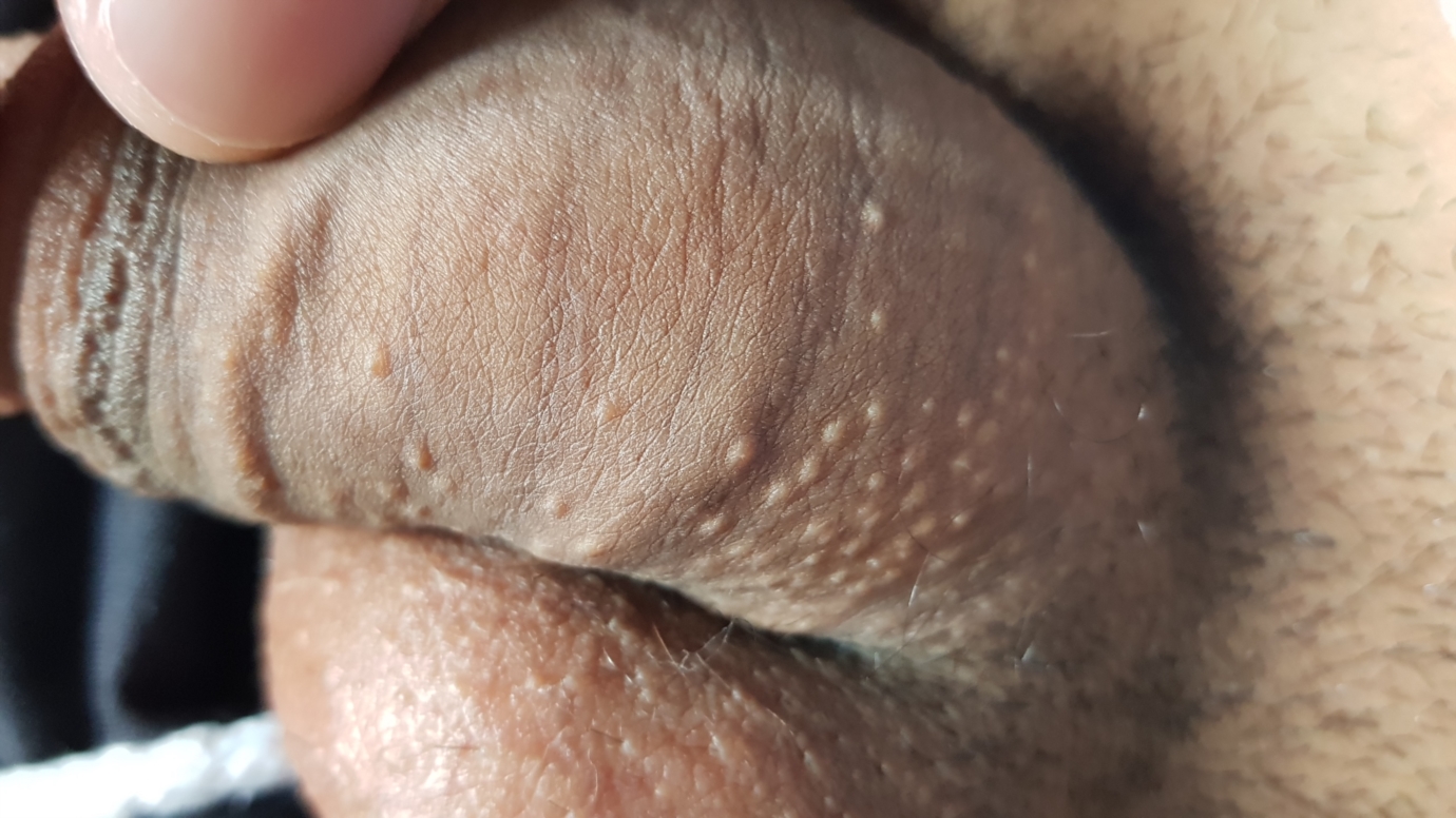 Small sized pale white spots on penis.
