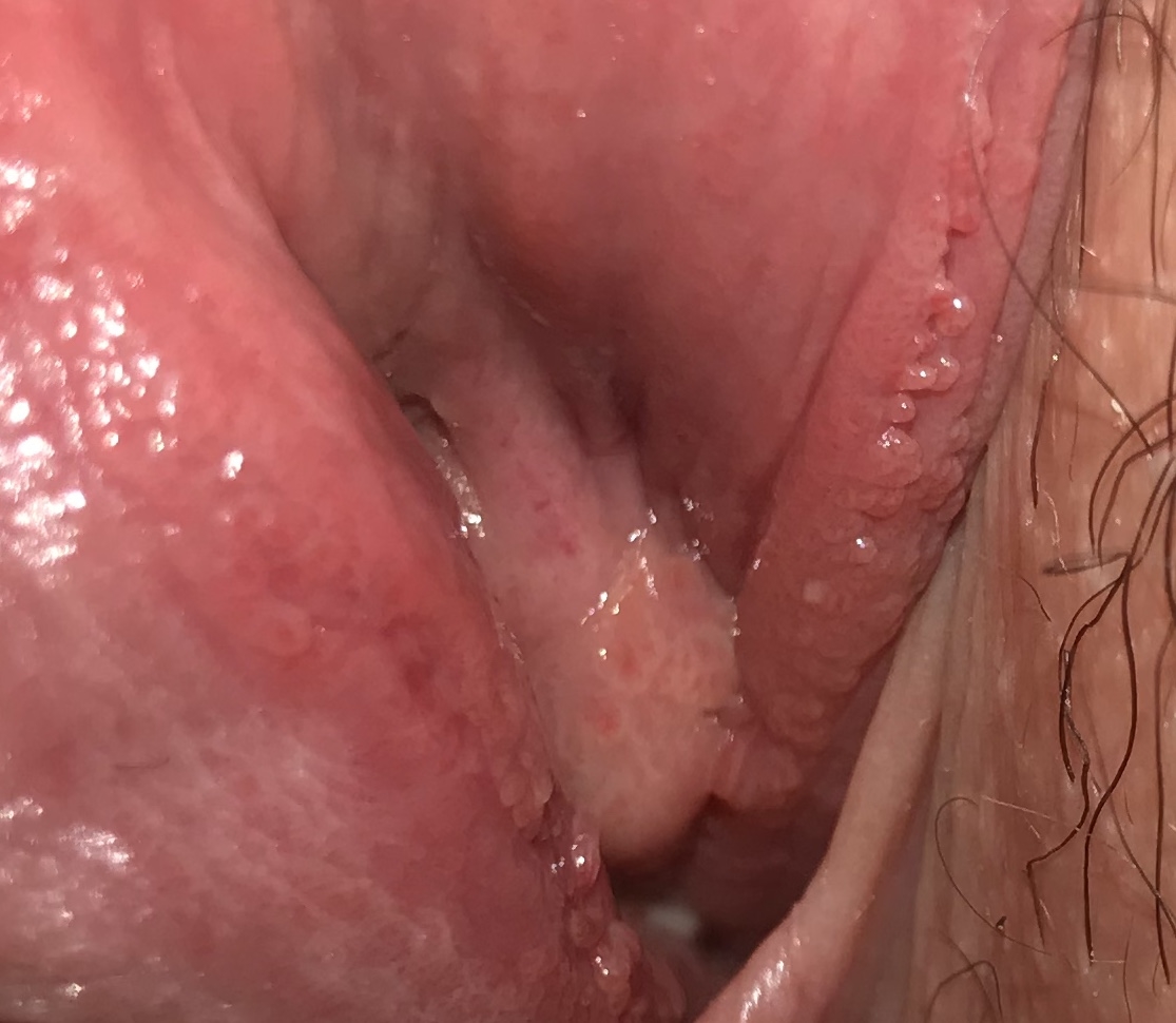 Vestibular papillomatosis or herpes.