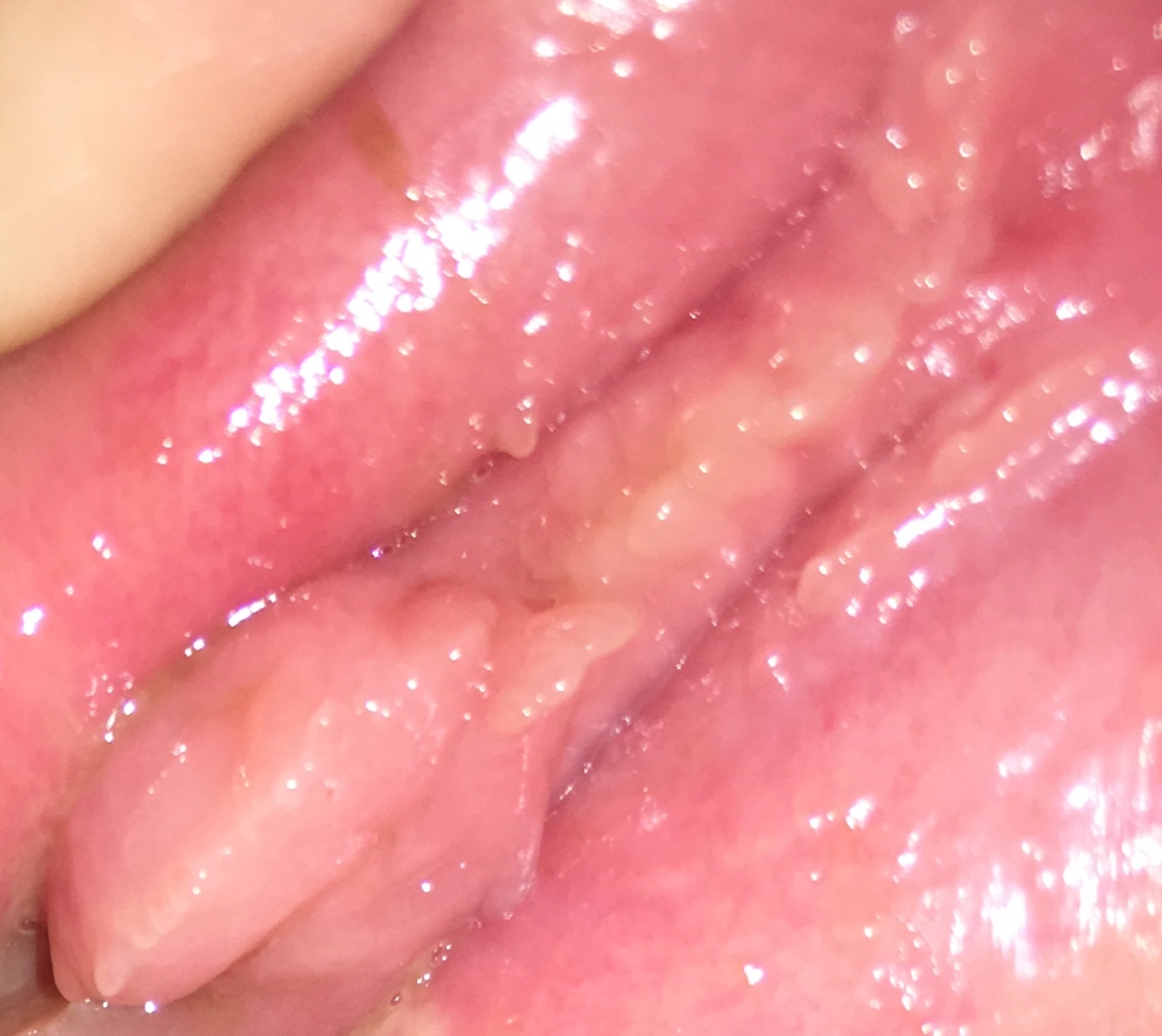 Vestibularis papillomatosis fogamzásgátlás, Vestibular papillomatosis - Nőgyógyászati betegségek