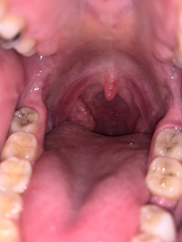 Is It Normal For My Throat To Look This Way Sexual Health Forums