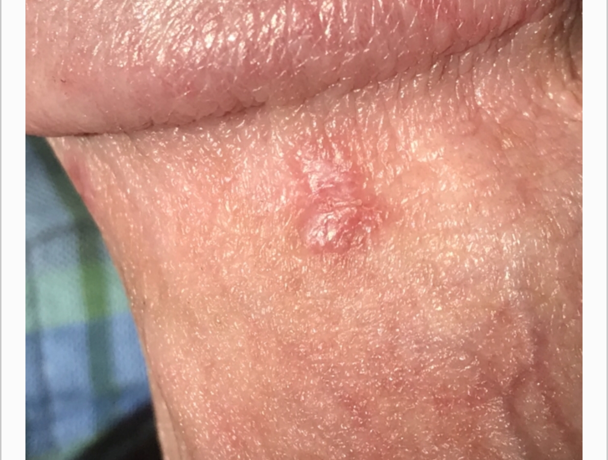 of white penis spots Stinging tip
