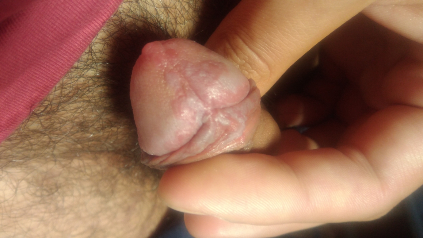 Asymptomatic Penile Rash