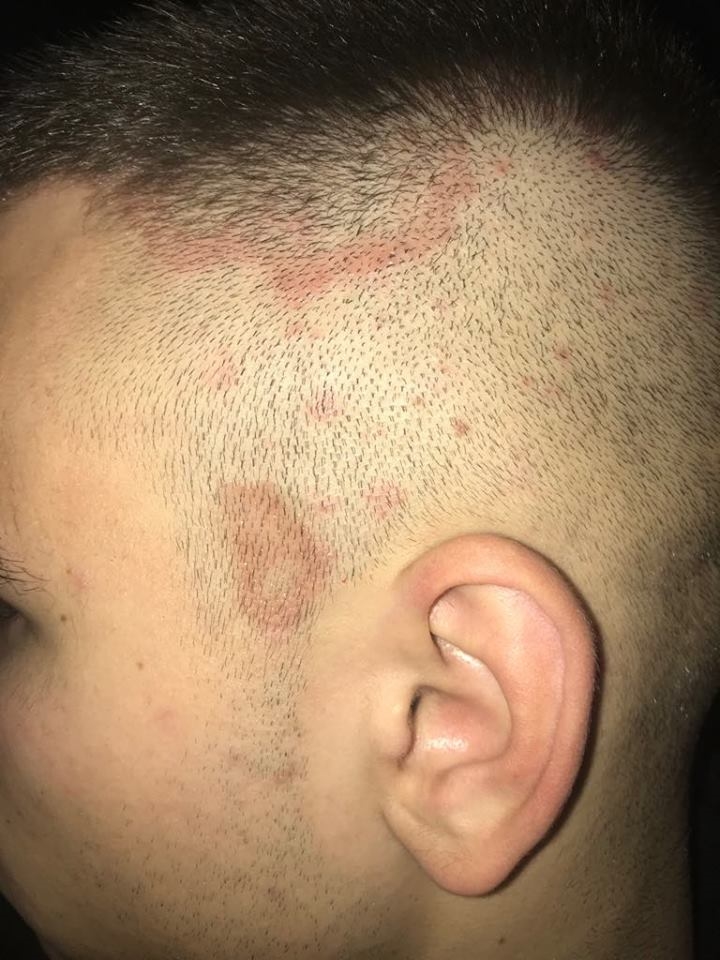 Red Spots On Head Dermatology Forums Patient