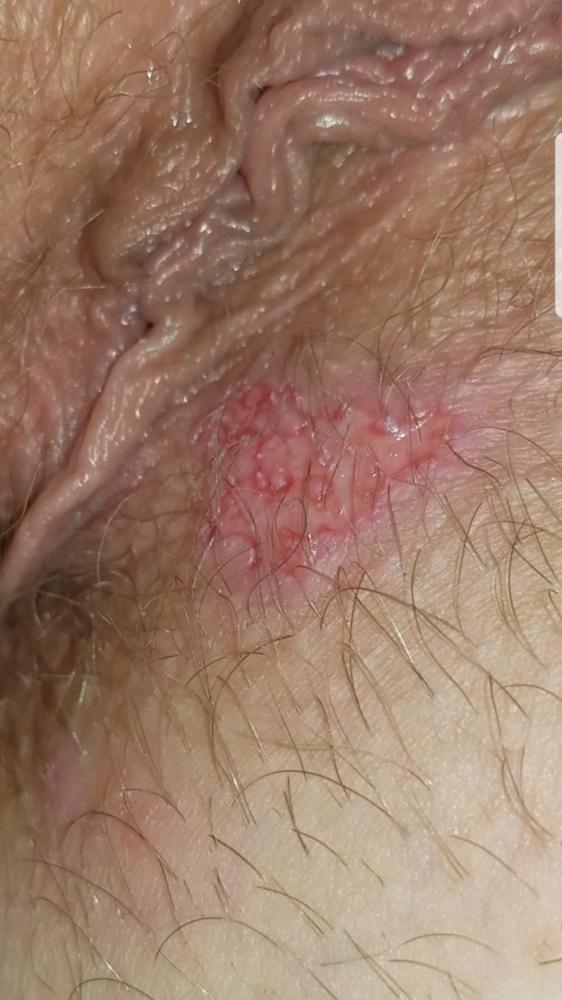 Red bumps around vaginal area