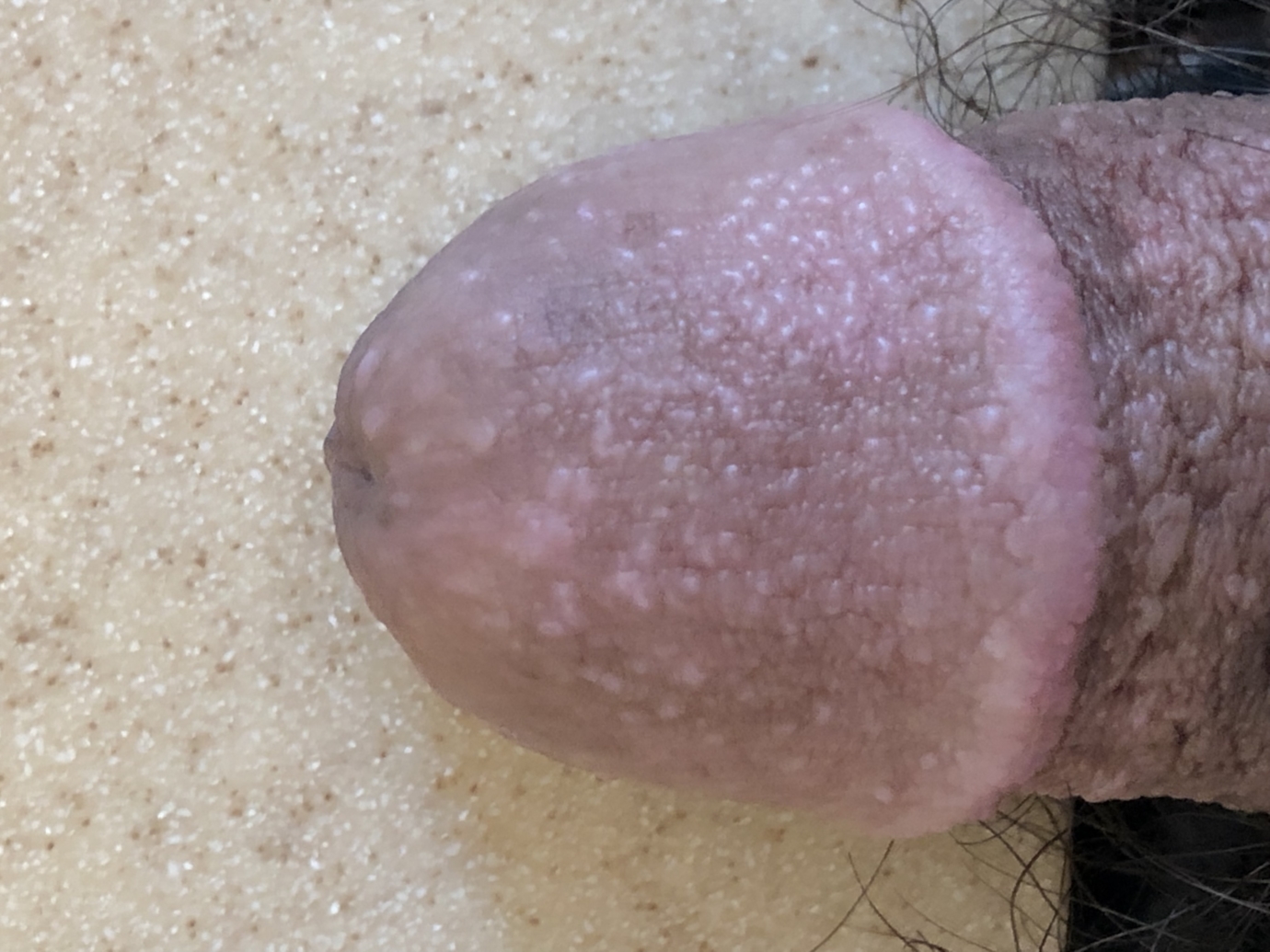 Tiny white bump on dick