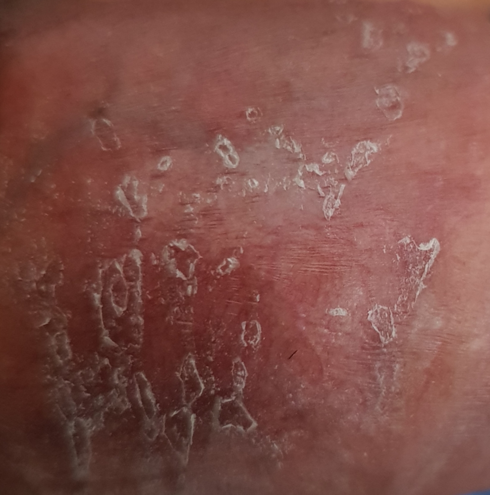 Bumps penis sex on red after Rash on