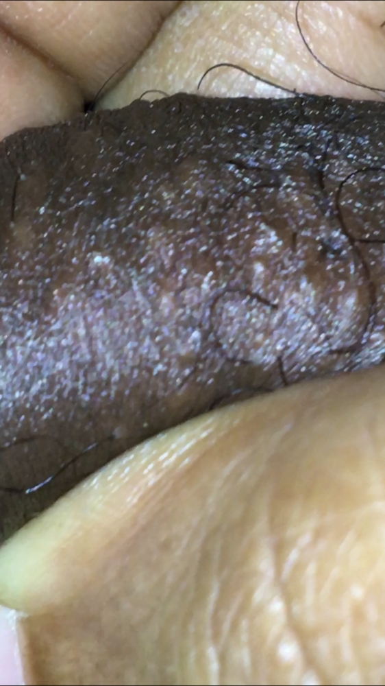 Is this herpes or folliculitis | Genital Herpes Simplex ...