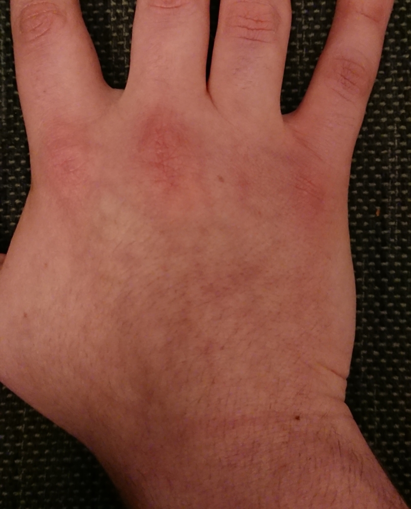 Year long rash on back of hand Dermatology Forums