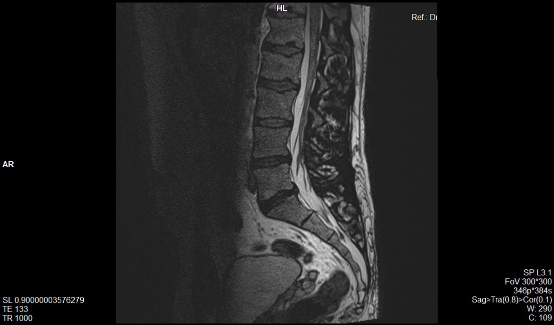 LOWER BACK PAIN_MRI ATTACHED . SOME ADVICE REQUIRED FROM FELLOW