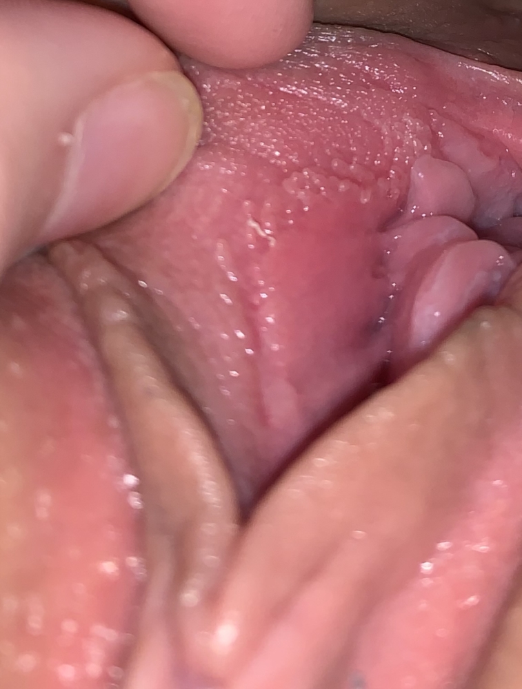 Weird bumps on vagina