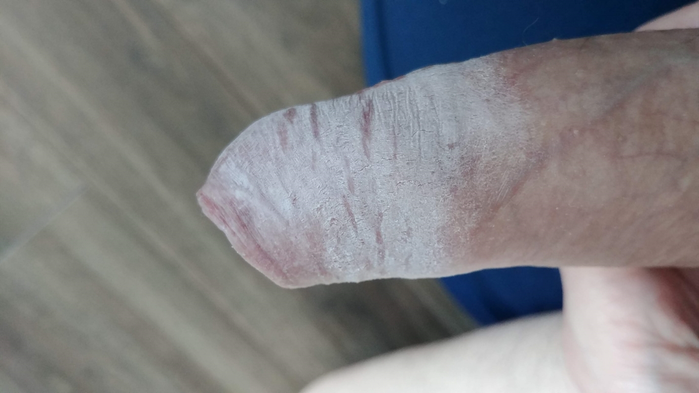 Penis Skin White Dry Skin - STI or else ? | Sexual Health | Forums | Patient