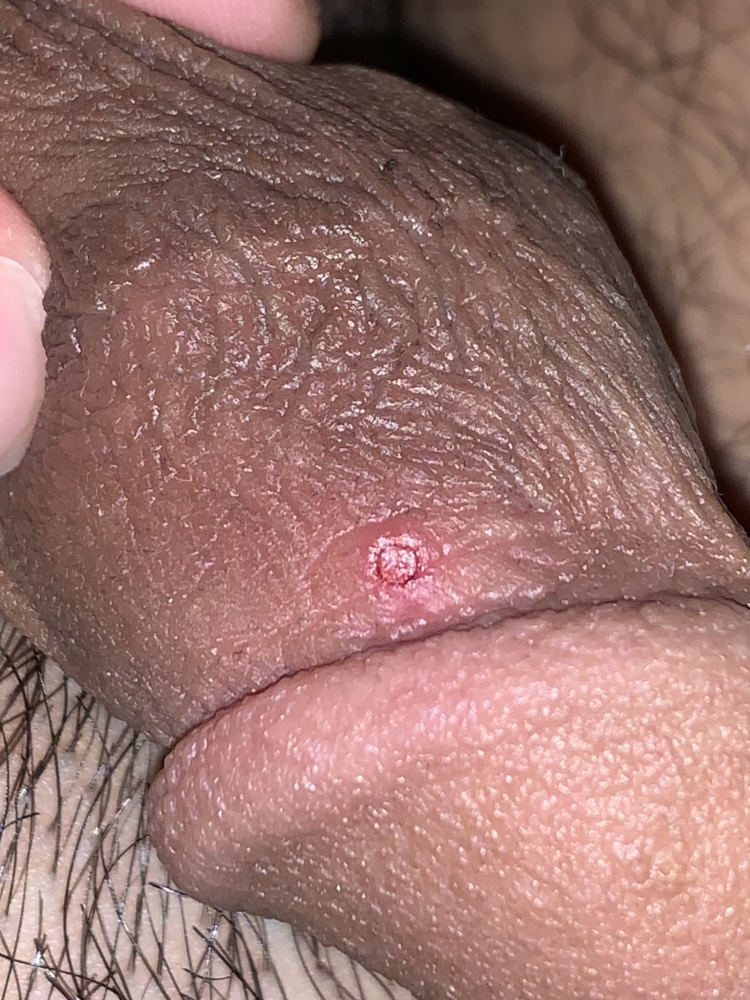 What To Do About Acne On The Penis