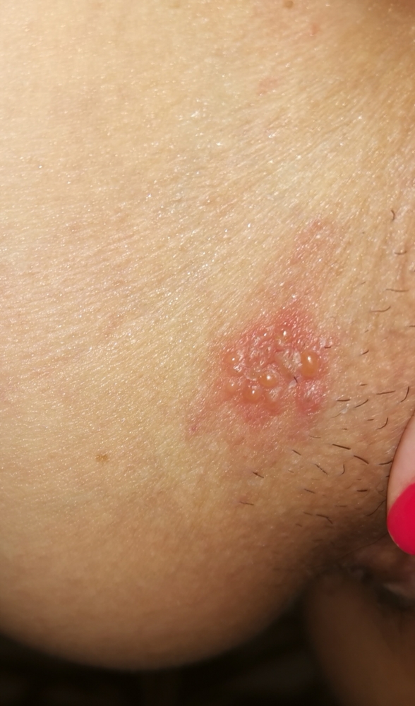 Help! Is this herpes? Blister outbreak | Genital Herpes Simplex