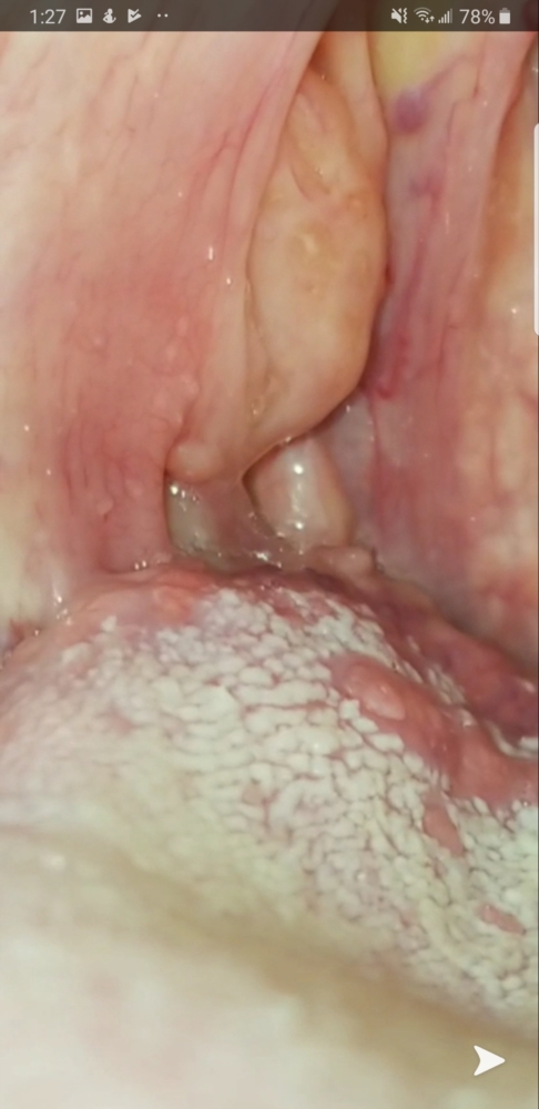 hpv warts in my throat