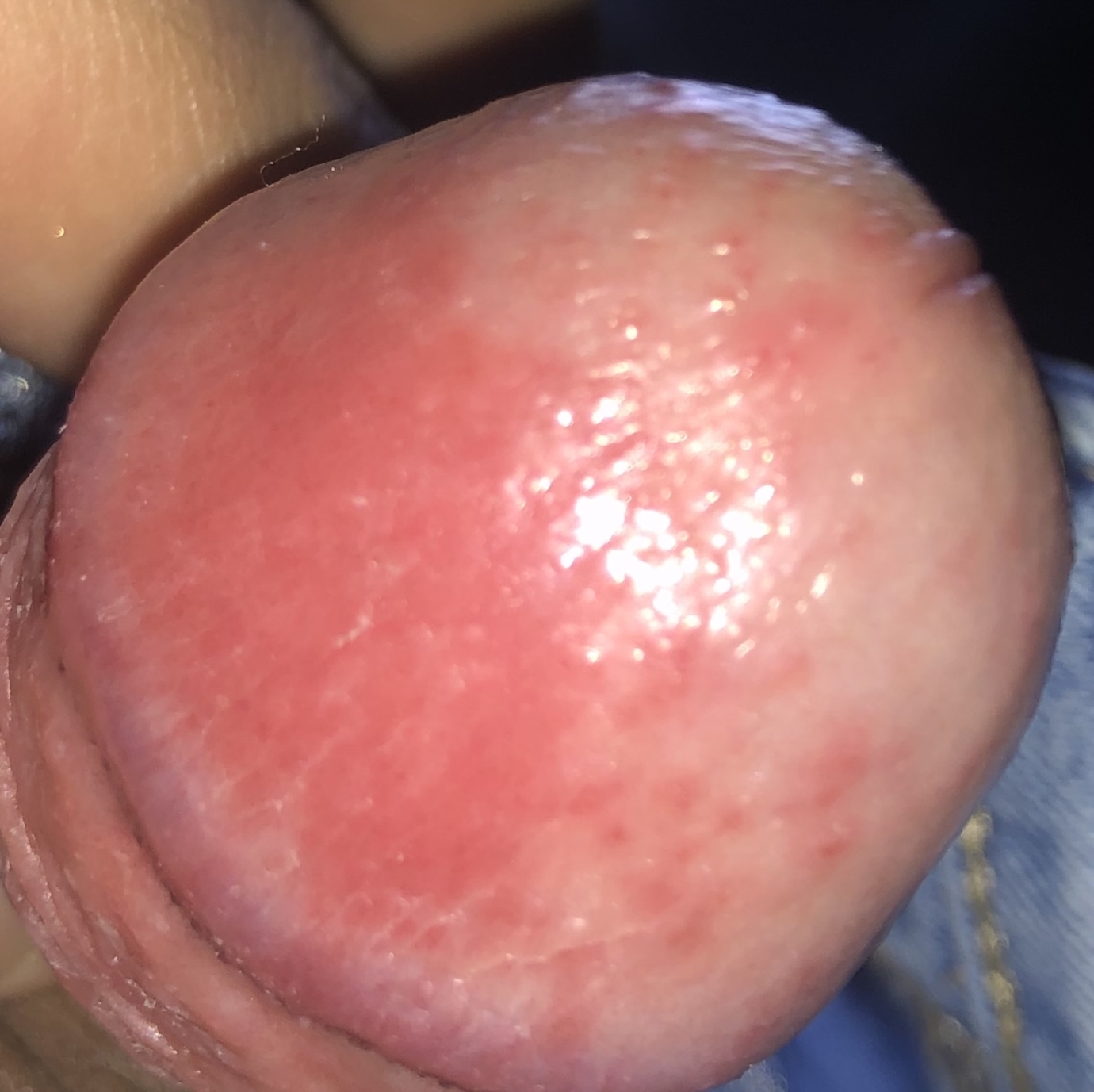 Around of penis head dots Penis irritation