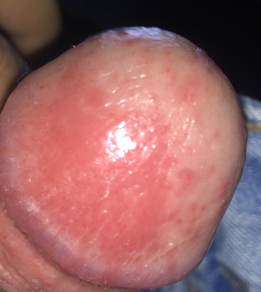 Head dots around penis Red Spot