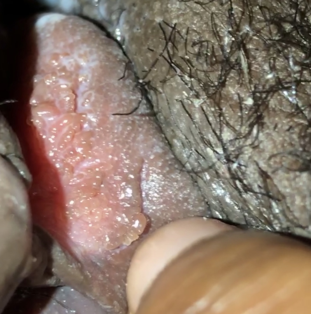 I Have Noticed These Bump Type Things On My Vulva They Itch Sometimes