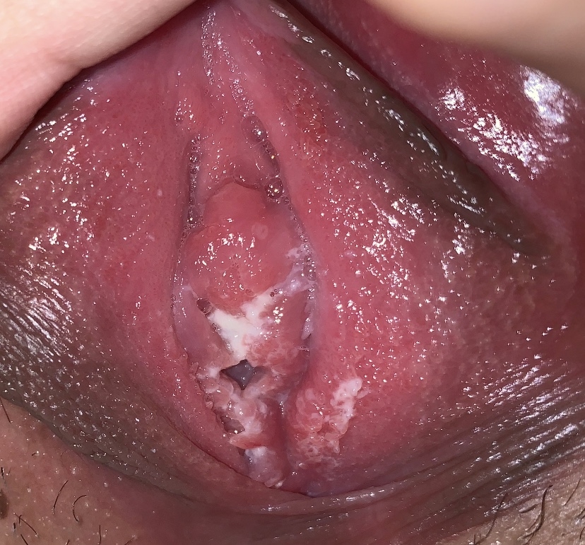 Persistent or recurrent vaginal discharge