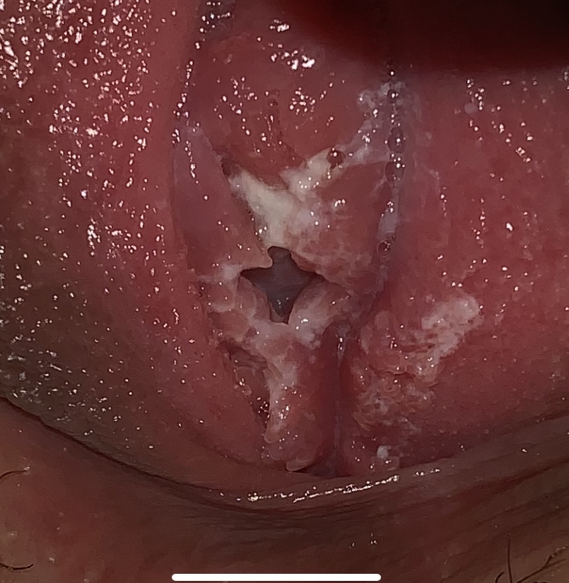 Hpv virus cause discharge