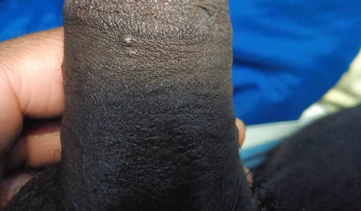 White pimples on penis