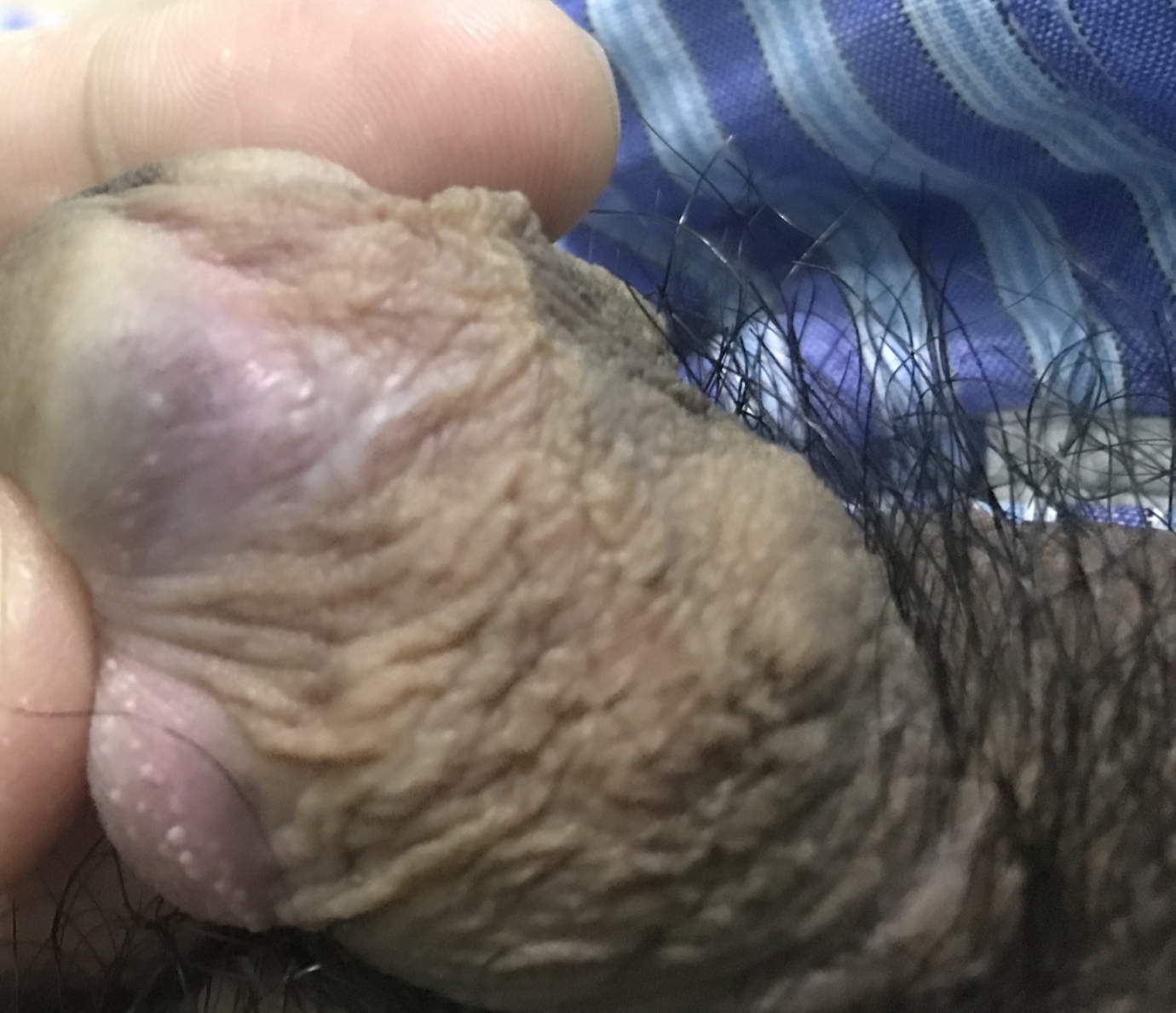 Itchy penis dry skin