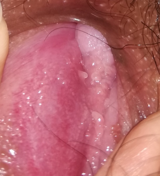 Vestibular papillomatosis dangerous, Vestibular papillomatosis on tongue