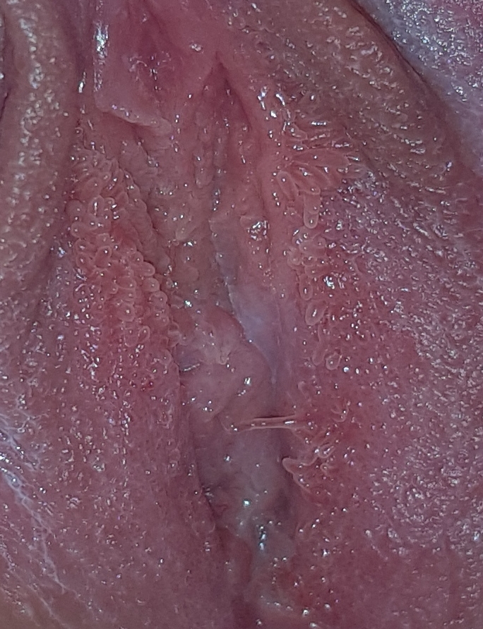 Is This Hpv I Am So Scared Sexual Health Forums Patient
