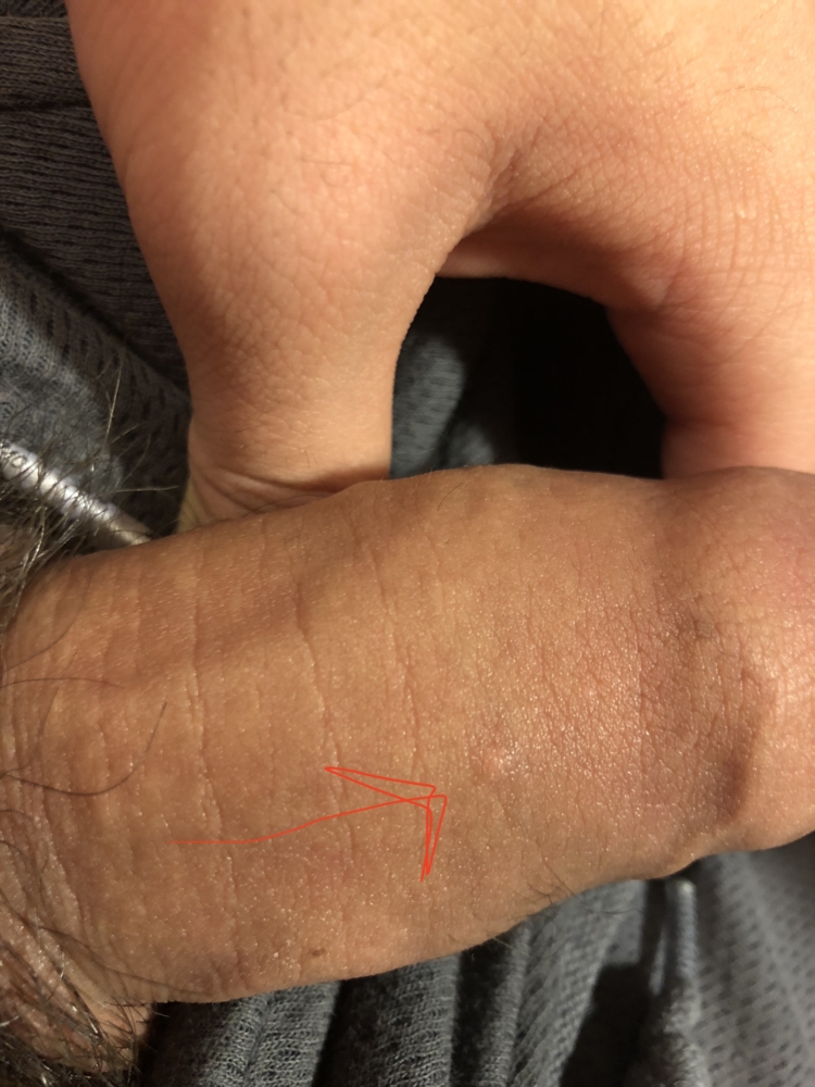 White-Yellowish Bump on Penis Upper Mid Section.
