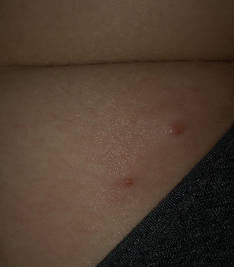Pimple Boil Or Herpes On Buttocks Genital Herpes Simplex Forums Patient