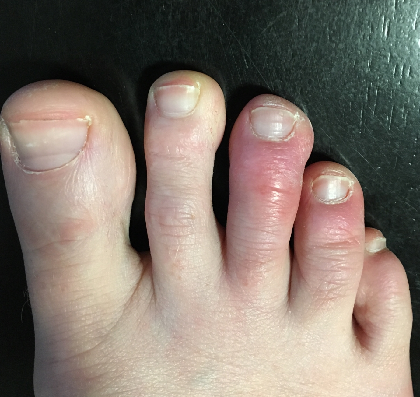 What S Wrong With My Toes Chilblains Foot And Toe