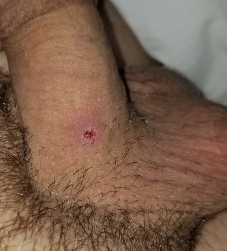 Ingrown hair cyst and how to cure it