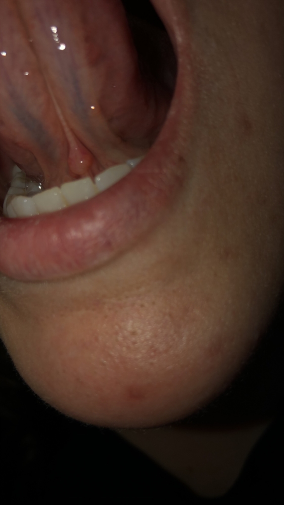 Small ball under tongue