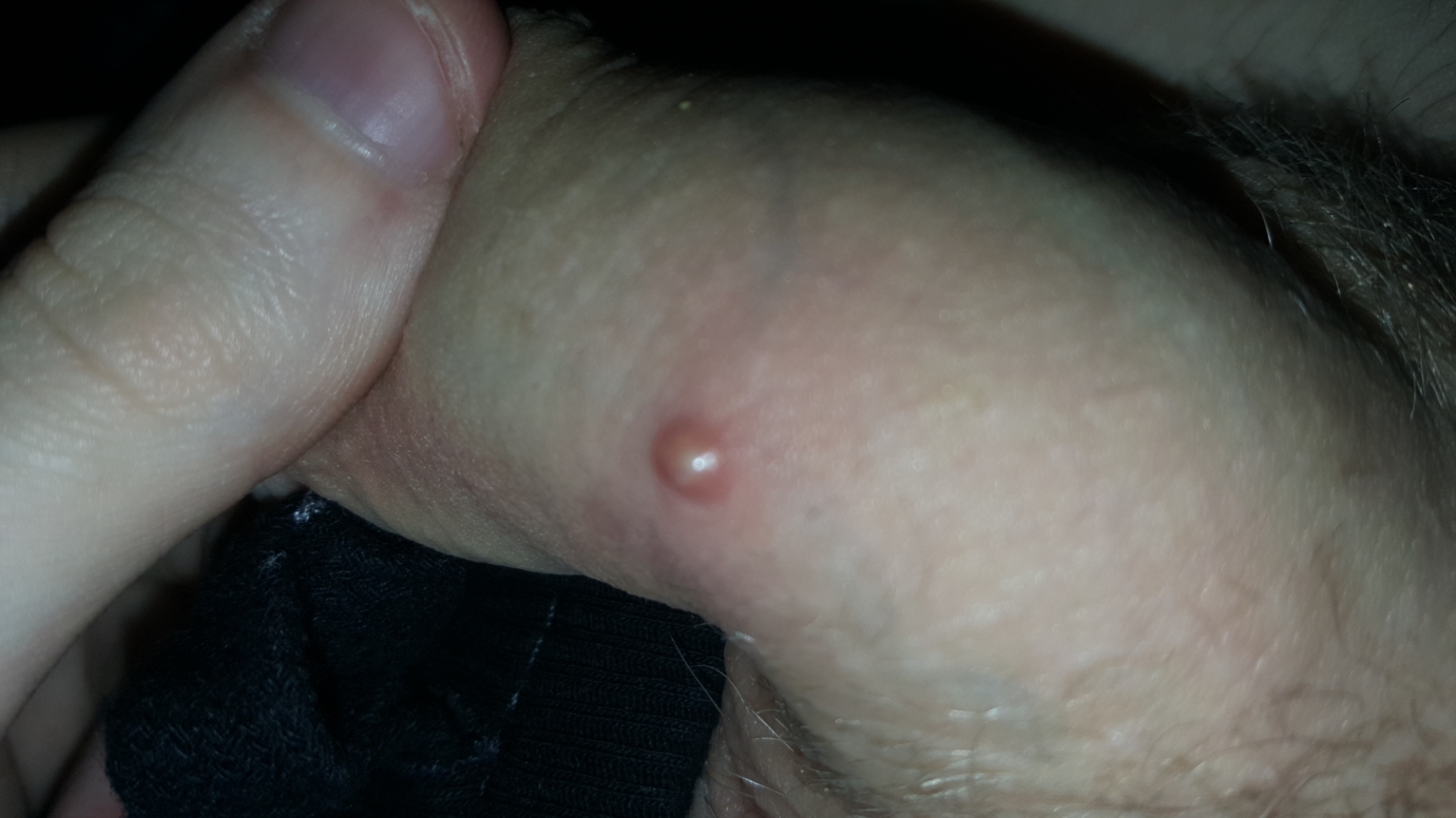 My dick on pimple I Have