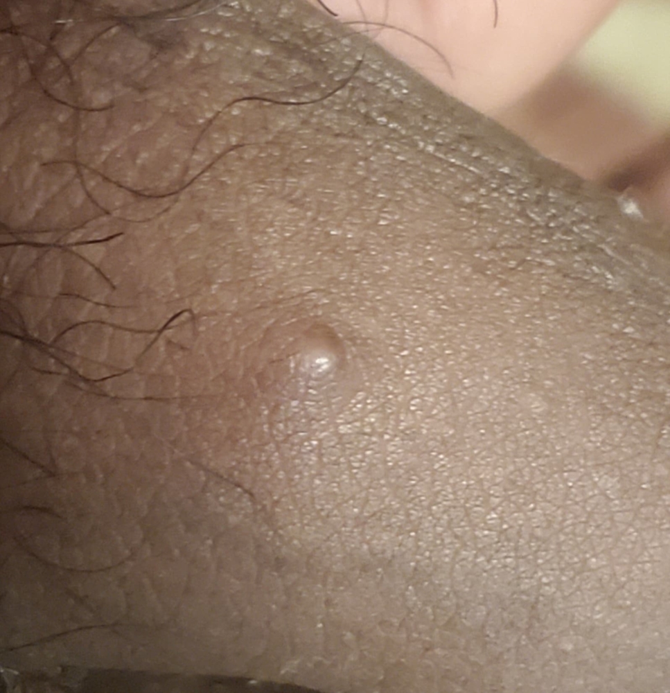 Pimple on my dick