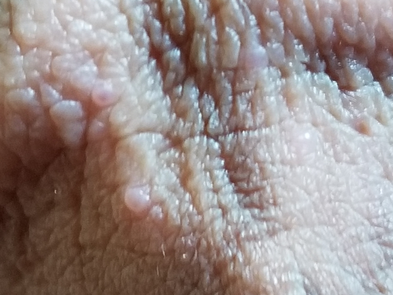 Tiny bumps around penis head