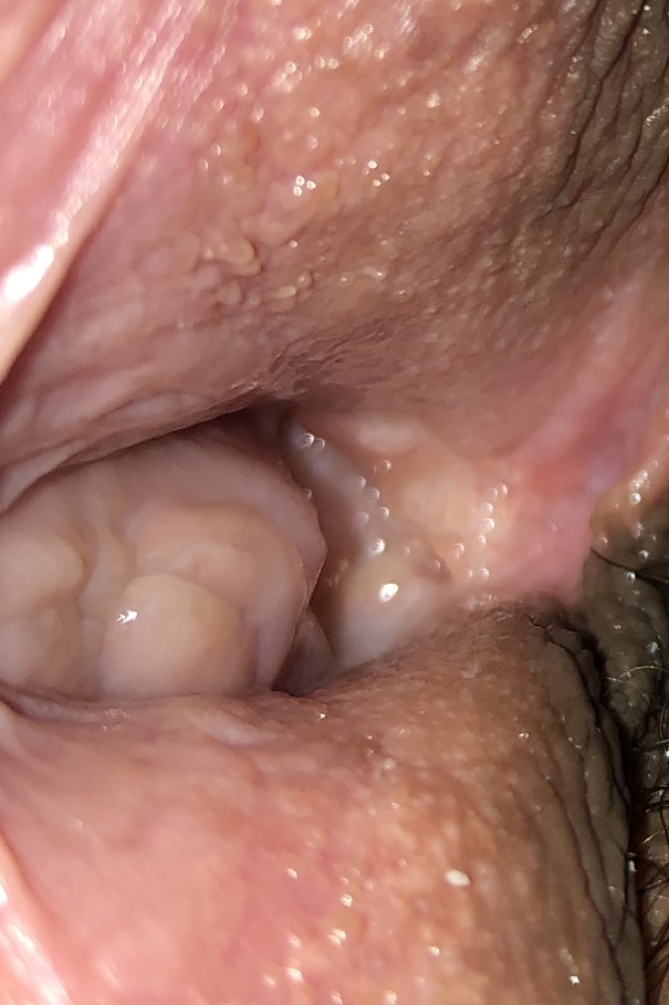 Benign neoplasms of the vagina