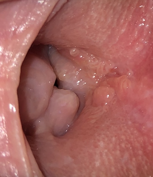 Hard spot on the inside lips of vagina