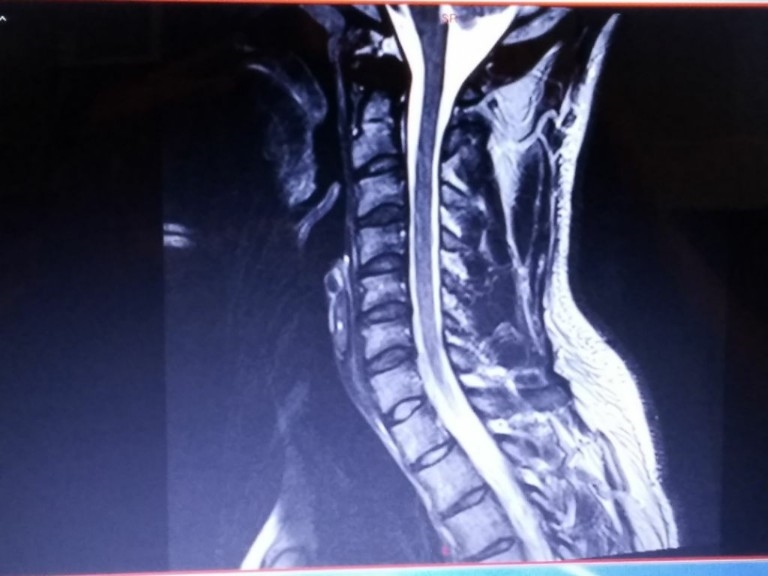 MRI of neck...please help | Other Conditions and General Health
