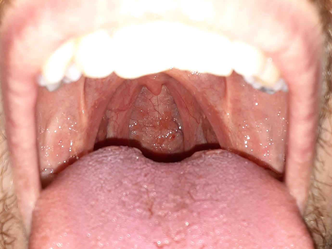 Red spots in throat. Strep or something else? Sore Throat | Forums | Patient