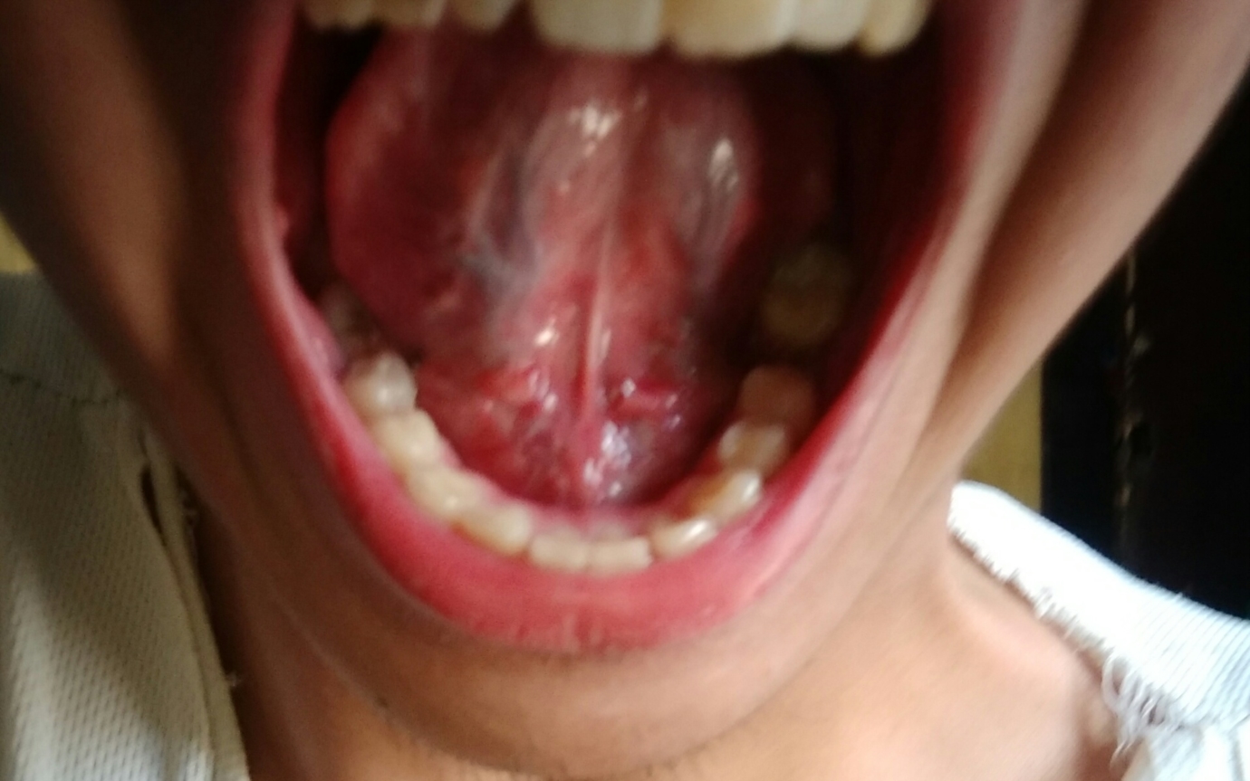 White Lump On Floor Of Mouth Viewfloor Co