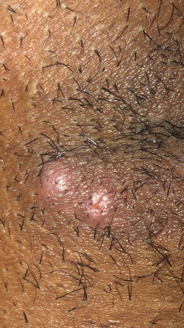 HELP! Does this look like herpes?! | Genital Herpes ...
