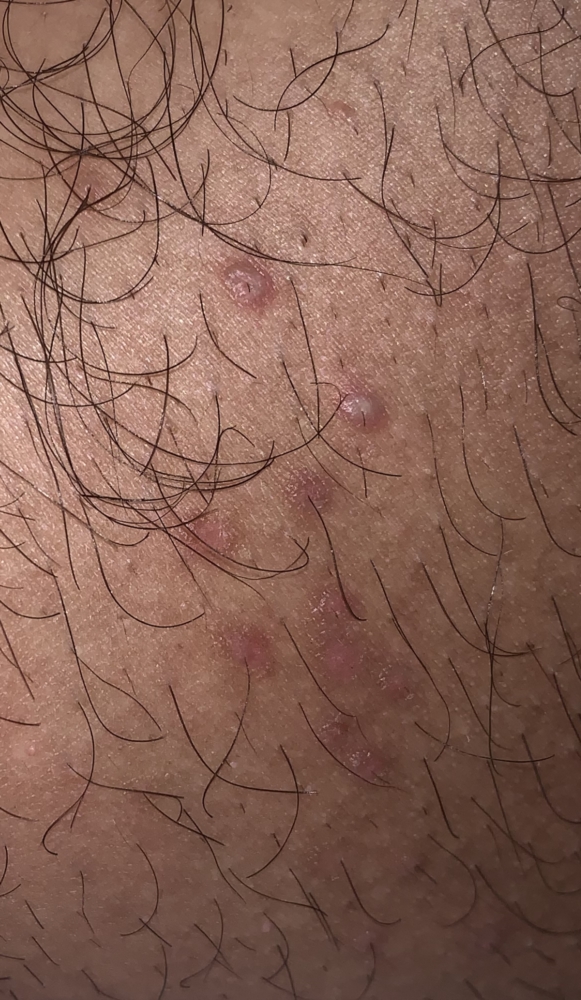 please help I'm freaking out (with pic) | Genital Herpes Simplex