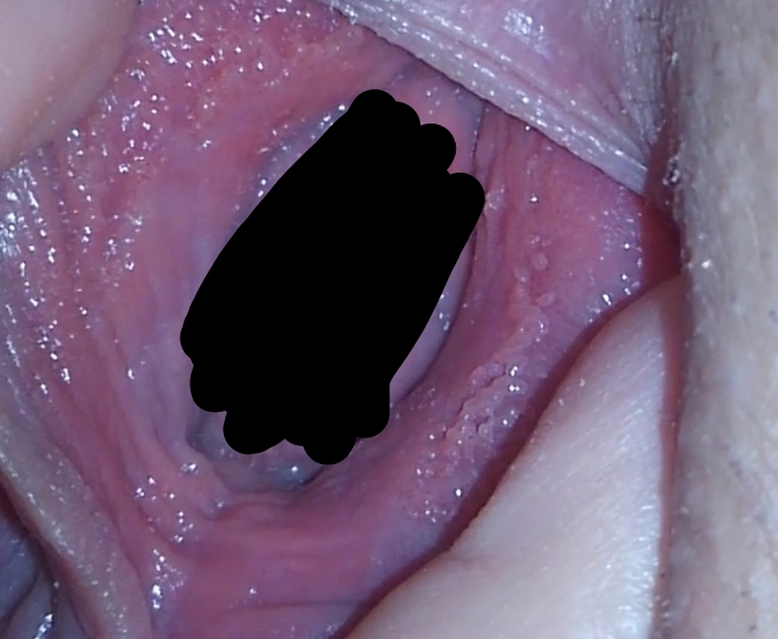 Vestibular papillomatosis patient handout Vestibular papillomatosis itchy.